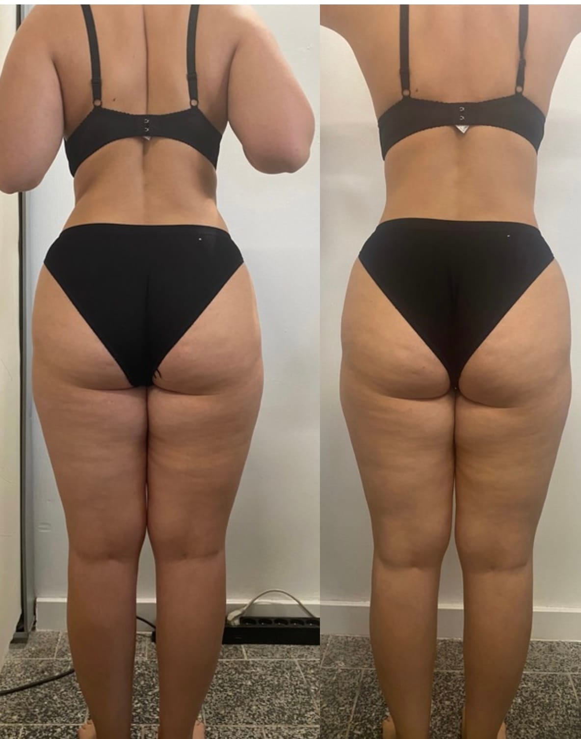 Efekt endermologii w&nbsp;Dhalia Day Spa, przed i&nbsp;po