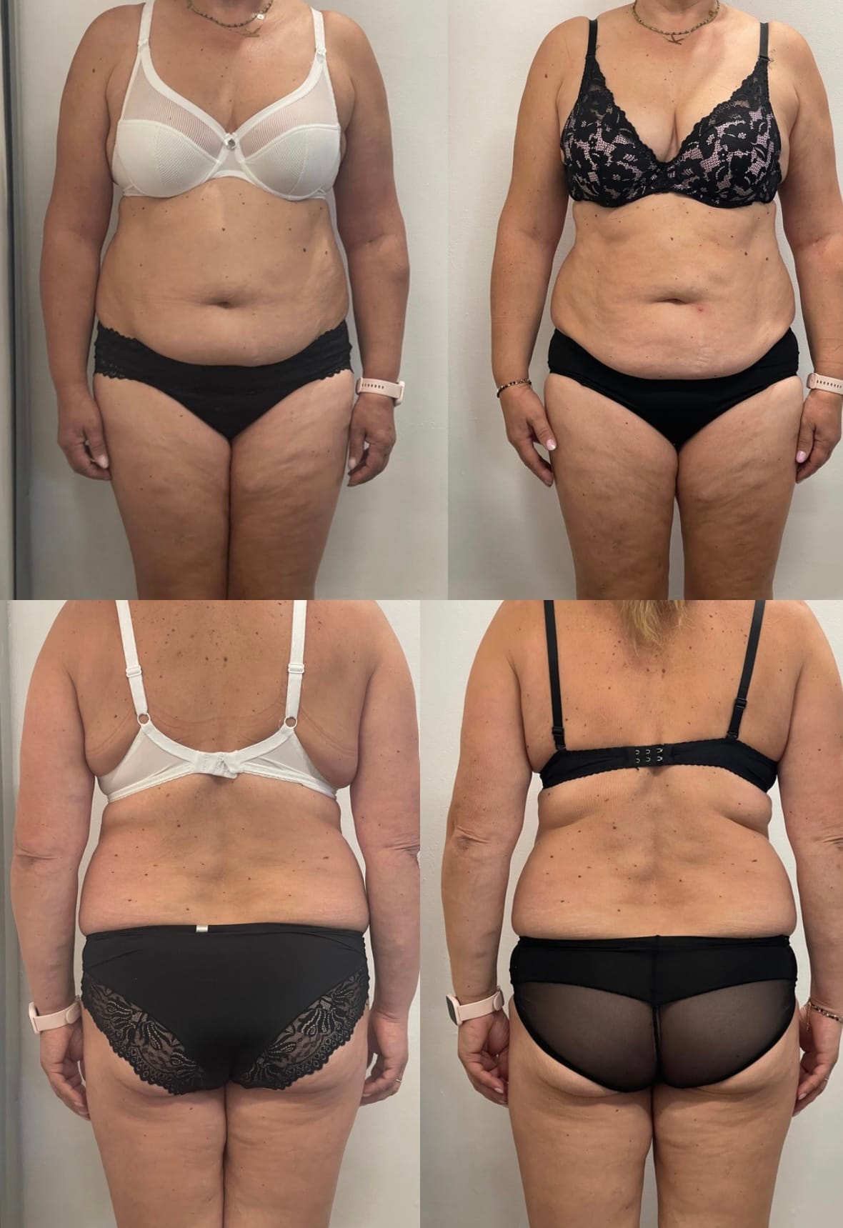 Efekt endermologii, modelowanie sylwetki