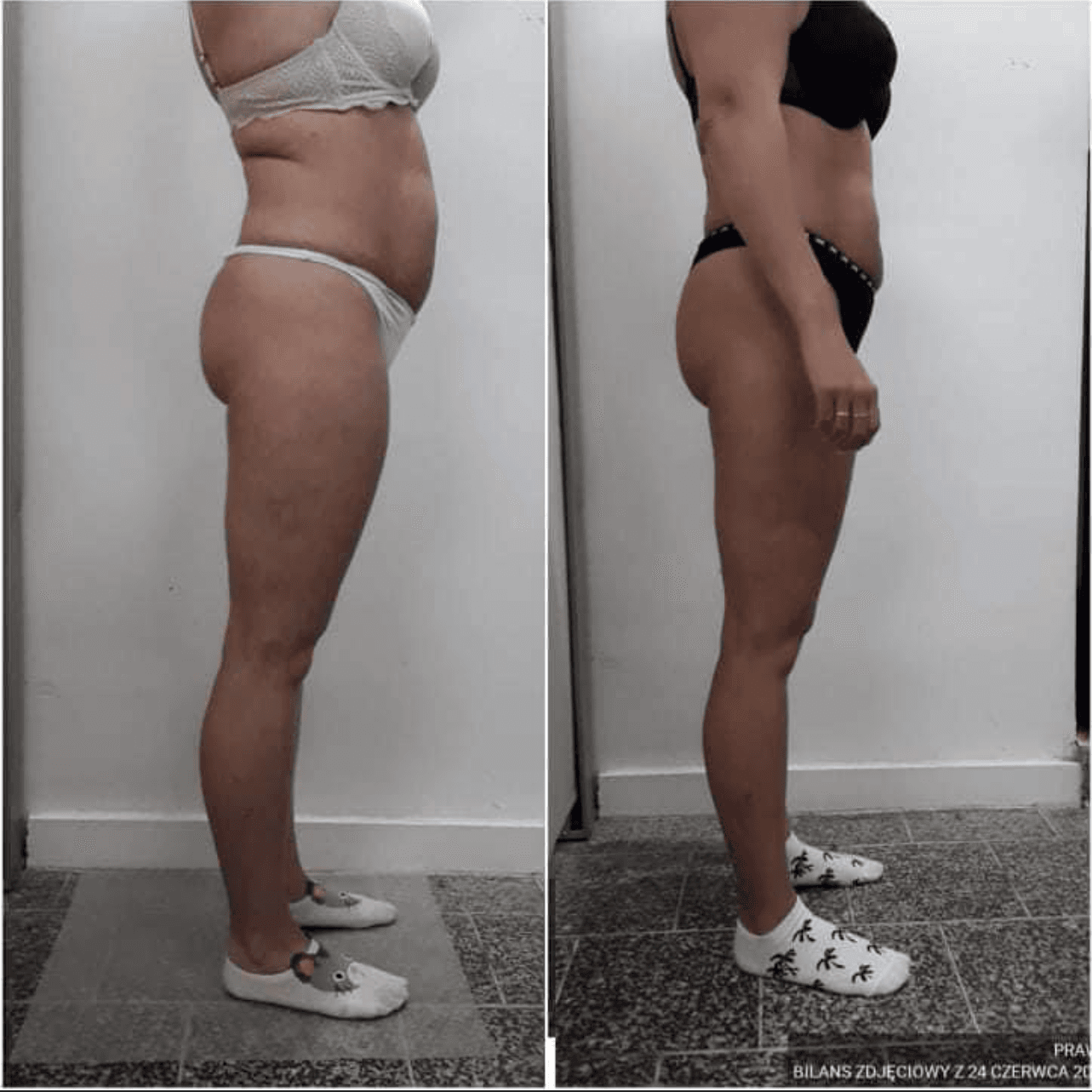 Efekt zabiegu endermologii w&nbsp;Dhalia Day Spa
