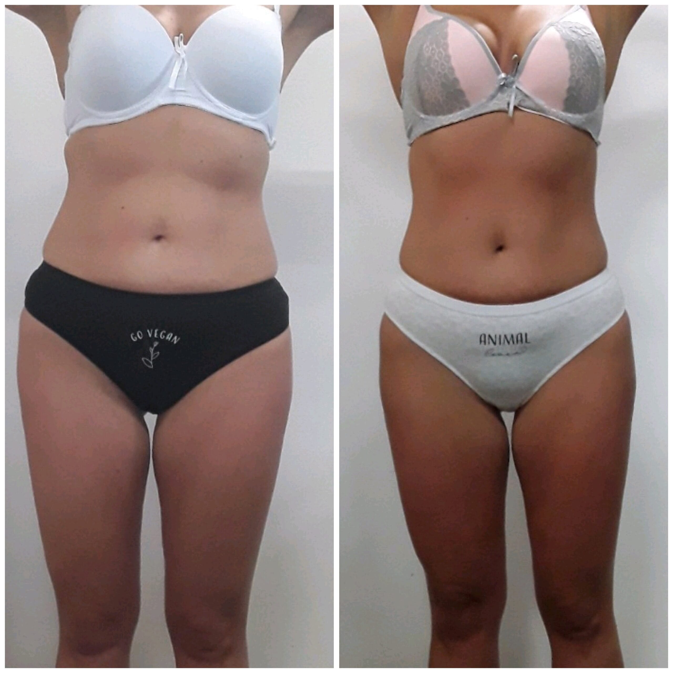 Efekt redukcji cellulitu endermologią