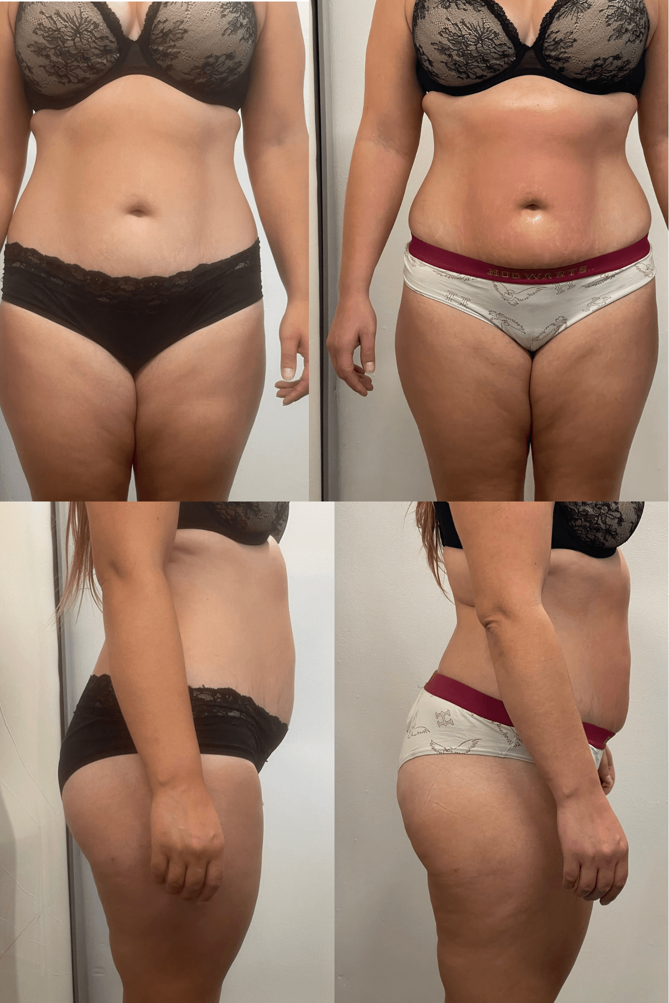 Efekt modelowania sylwetki endermologią